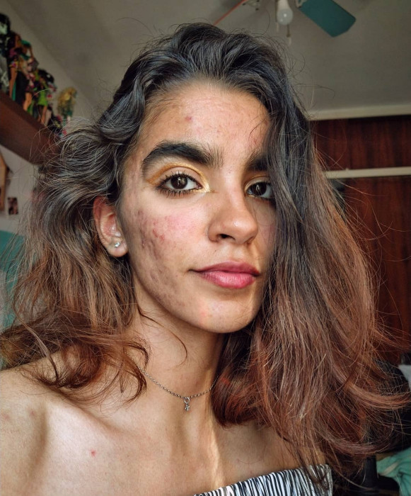 „Usłyszałam, że można się ode mnie zarazić i lepiej mnie nie dotykać” – mówi autorka profilu @skinnoshame, która na Instagramie pokazuje swój trądzik