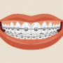Aparat ortodontyczny: co musisz wiedzieć, zanim go założysz